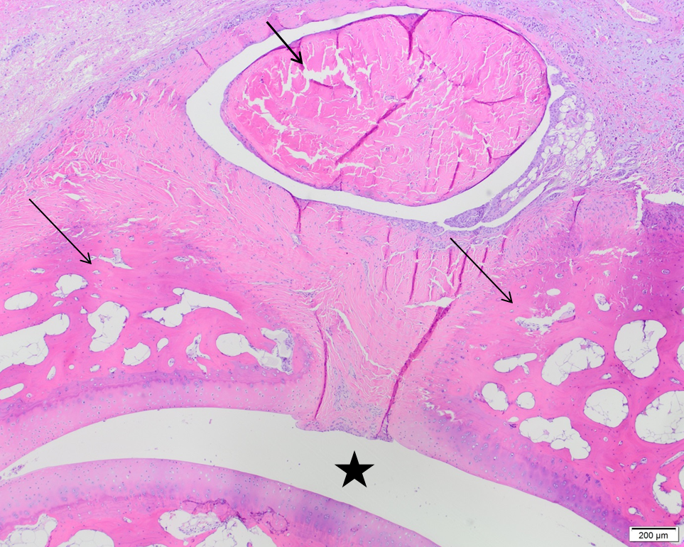 distale falanx